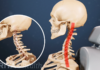 What Is Whiplash? Symptoms, Causes, Diagnosis, Treatment, and Prevention