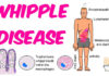 What Is Whipple Disease? Symptoms, Causes, Diagnosis, Treatment, and Prevention