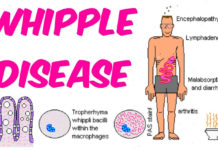 What Is Whipple Disease? Symptoms, Causes, Diagnosis, Treatment, and Prevention